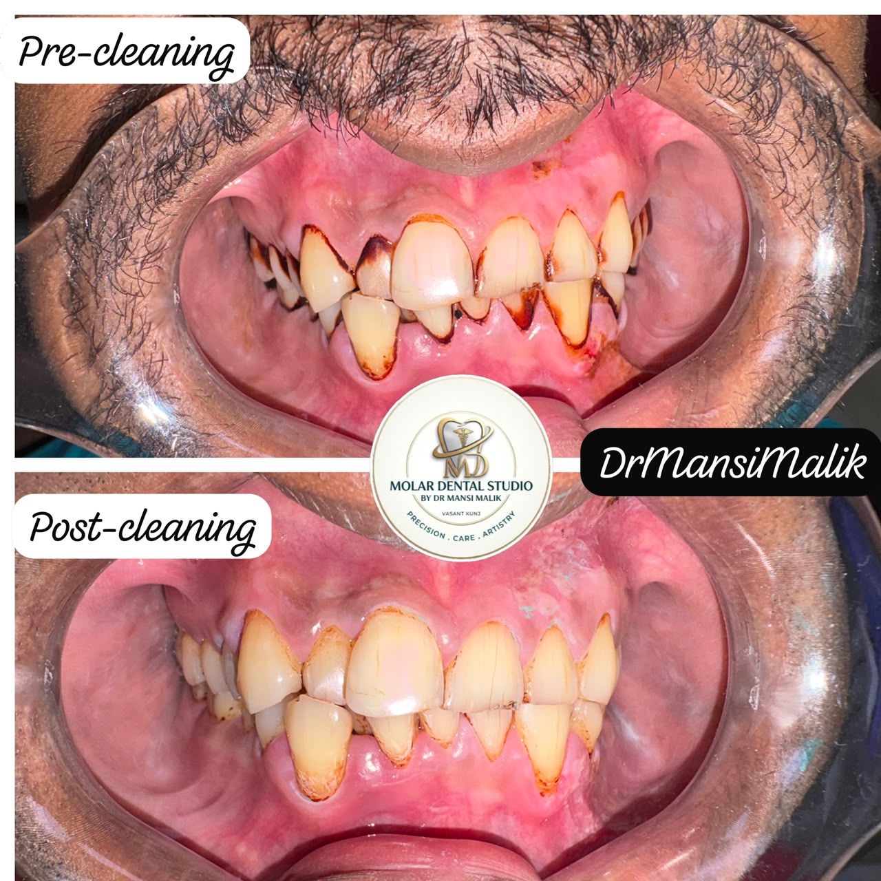 Before and after a scaling and deep cleaning: inflamed gums with heavy deposits, then clean gums after treatment