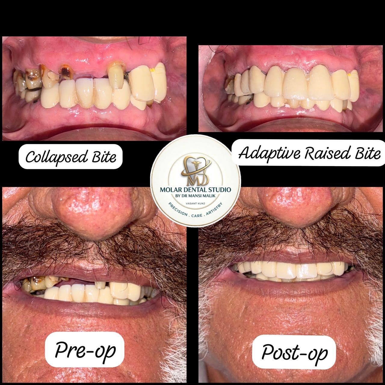 A collapsed bite rebuilt to an adaptive raised bite, shown pre-operatively and post-operatively