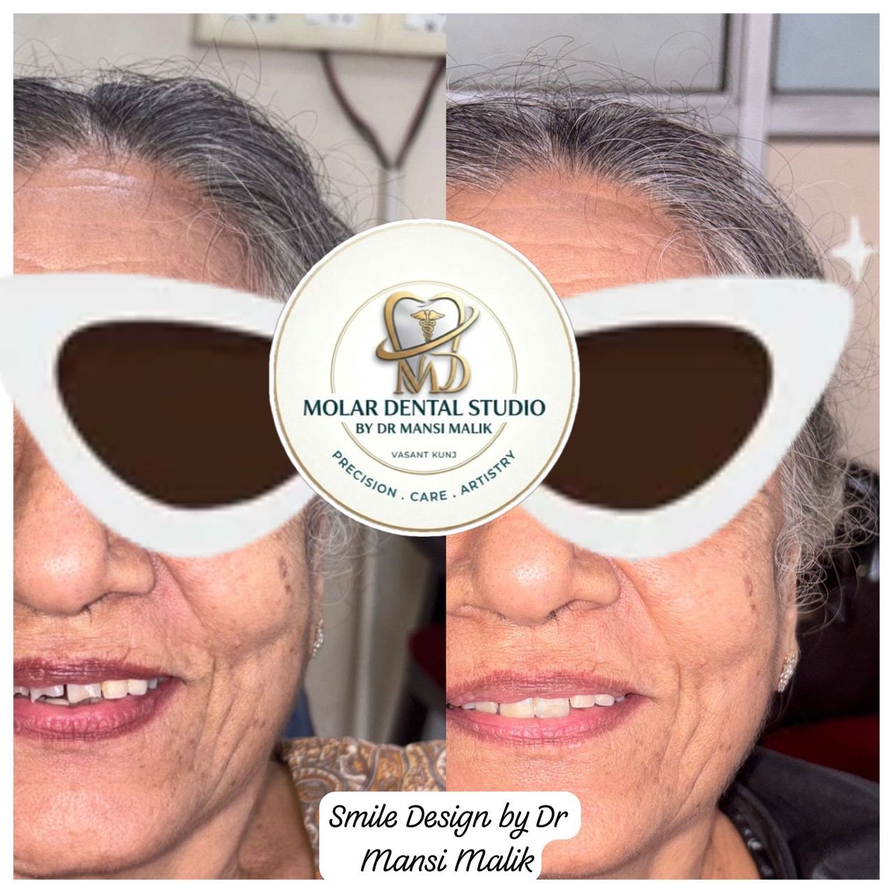 Smile design case by Dr. Mansi Malik, shown before and after treatment