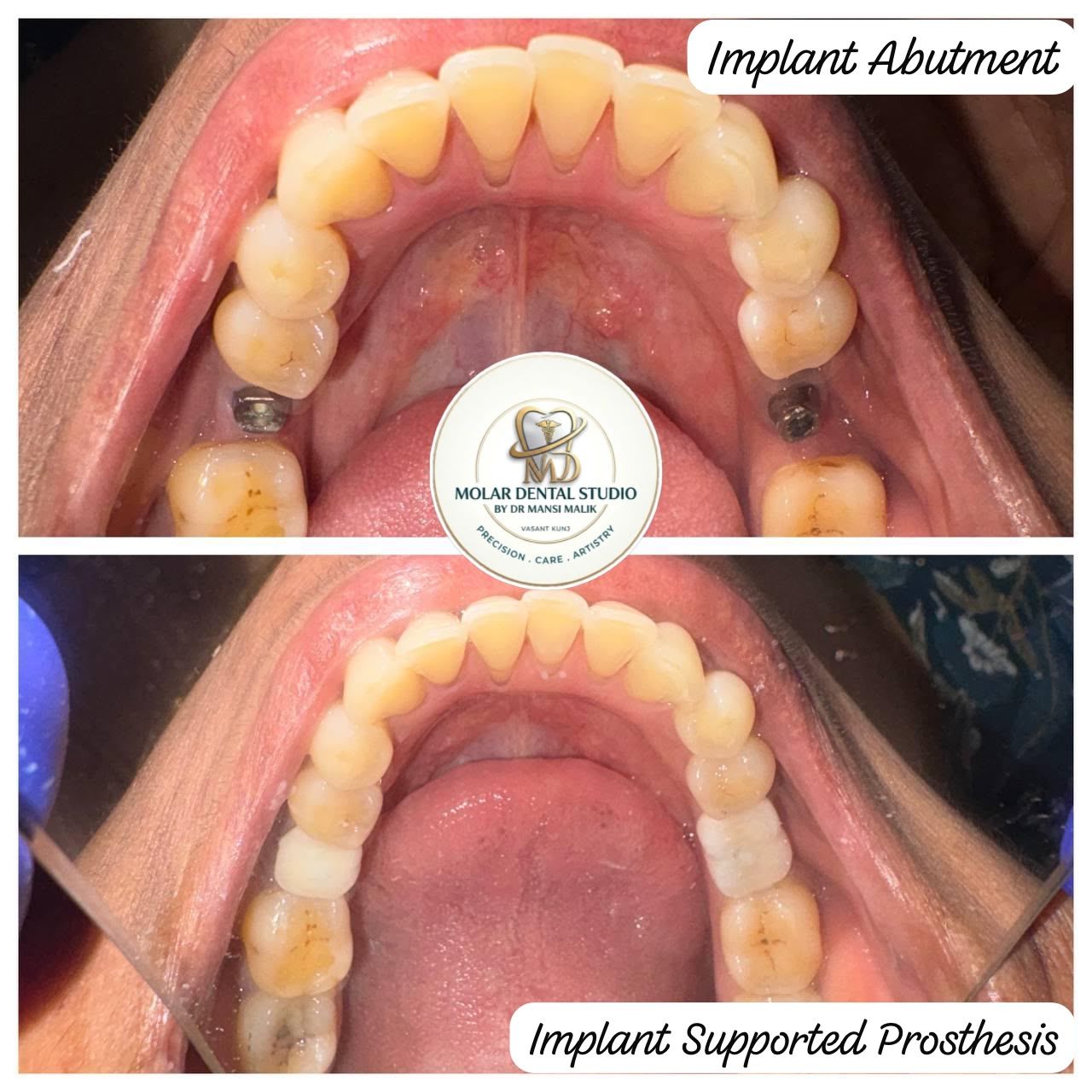 An implant abutment in place, then the finished implant-supported prosthesis fitted over it