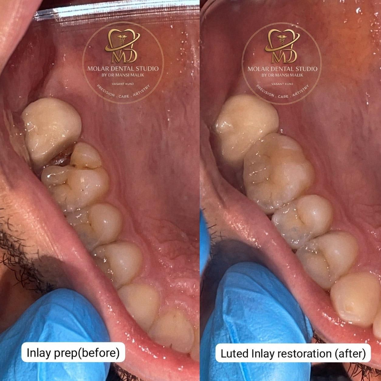 An inlay preparation in a back tooth, then the luted inlay restoration seated in place