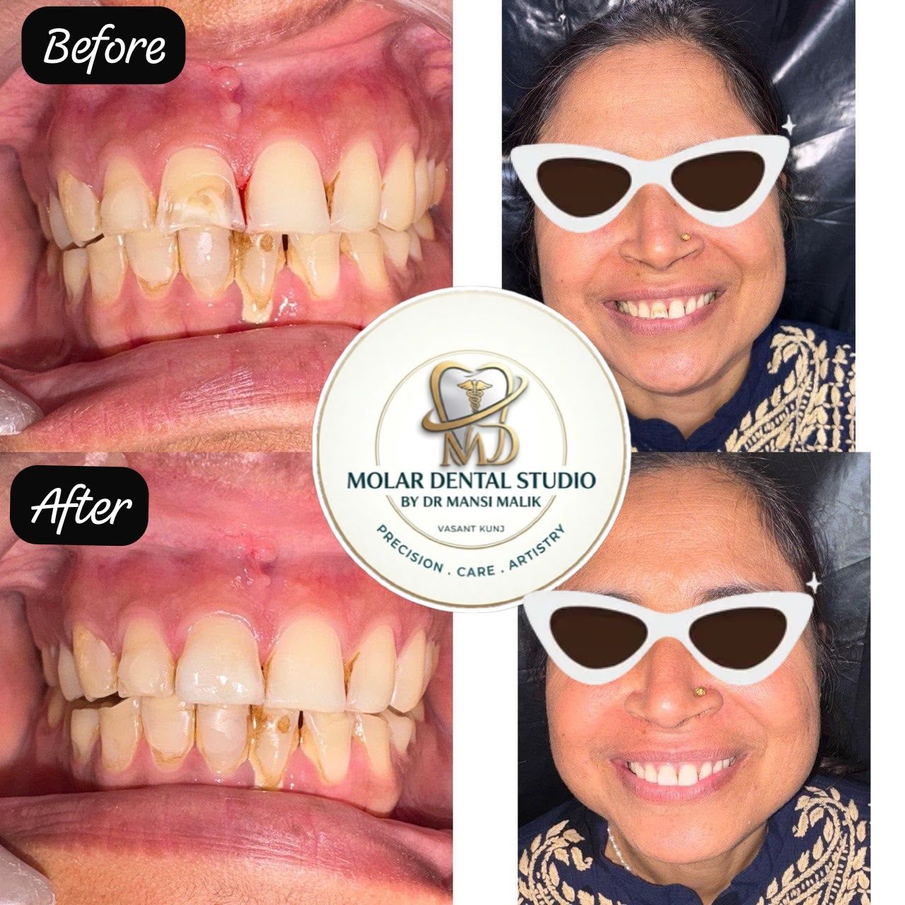 Before and after photographs of an indirect veneer case, with close-ups and the finished smile