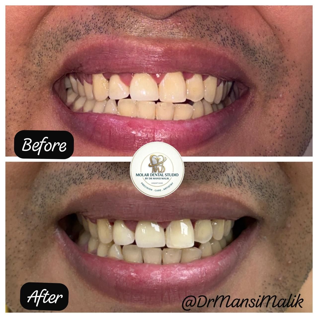 Close-up before and after photographs of a smile corrected at the clinic