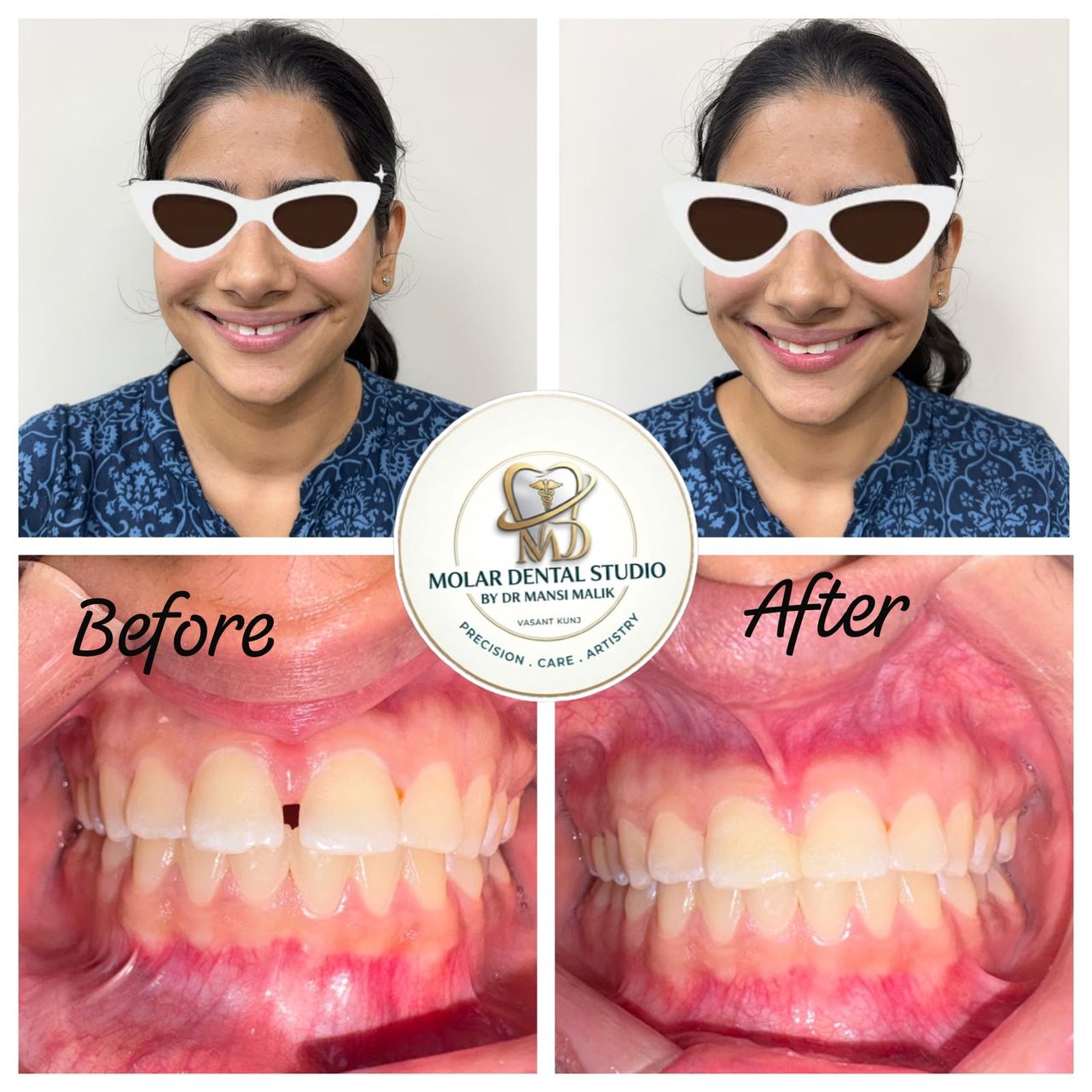 Before and after photographs of a gap between the front teeth closed with orthodontic treatment